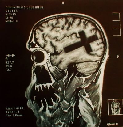 Parasitosis Cruciatus