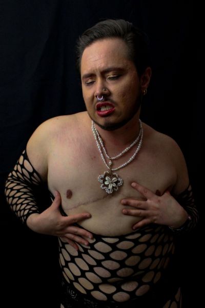 Double Incision Bilateral Mastectomy II