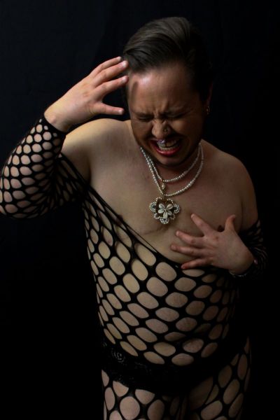 Double Incision Bilateral Mastectomy III